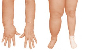 What is Lymphoedema? What is Lymphoedema?